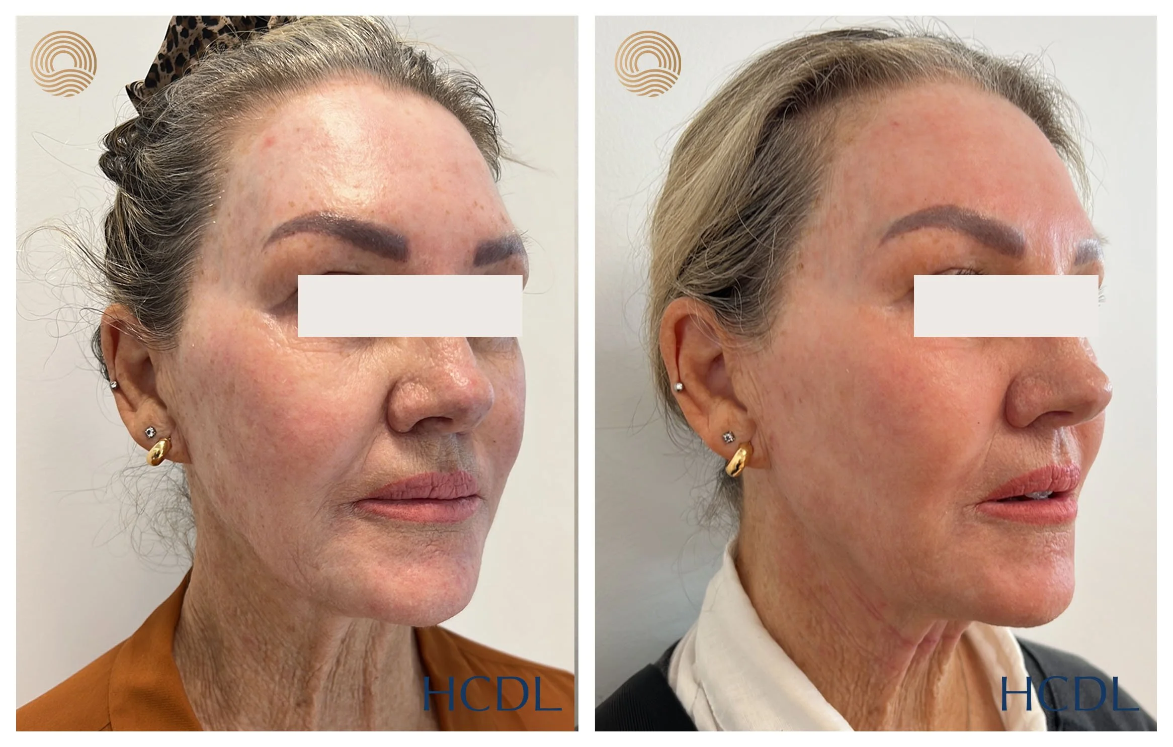 Resurfacing with CO2 Laser — Hunter Coast Dermatology & Laser ...